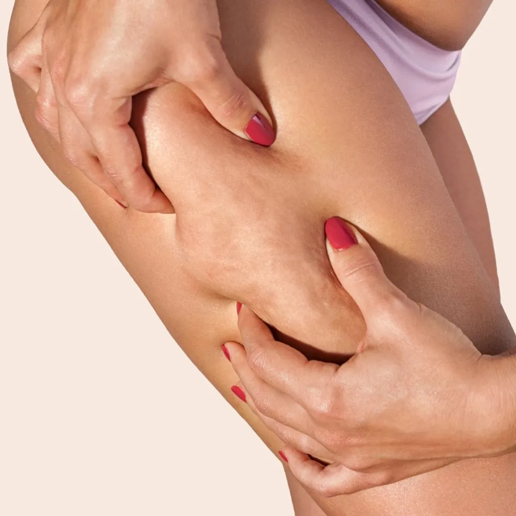 Cellulite-image