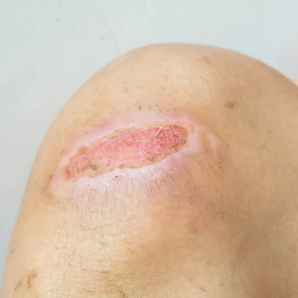 skin-lesion