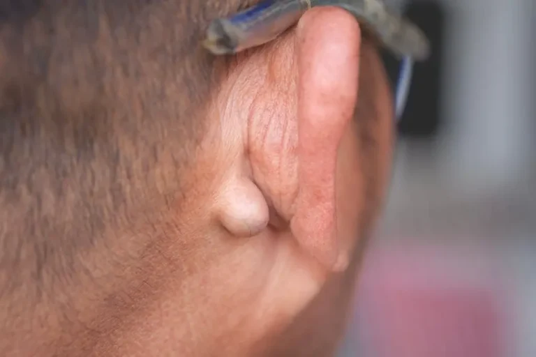 sebaceous-cyst-2