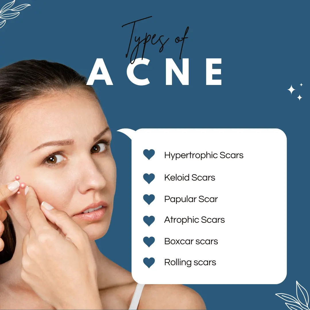 Types-Of-Acne