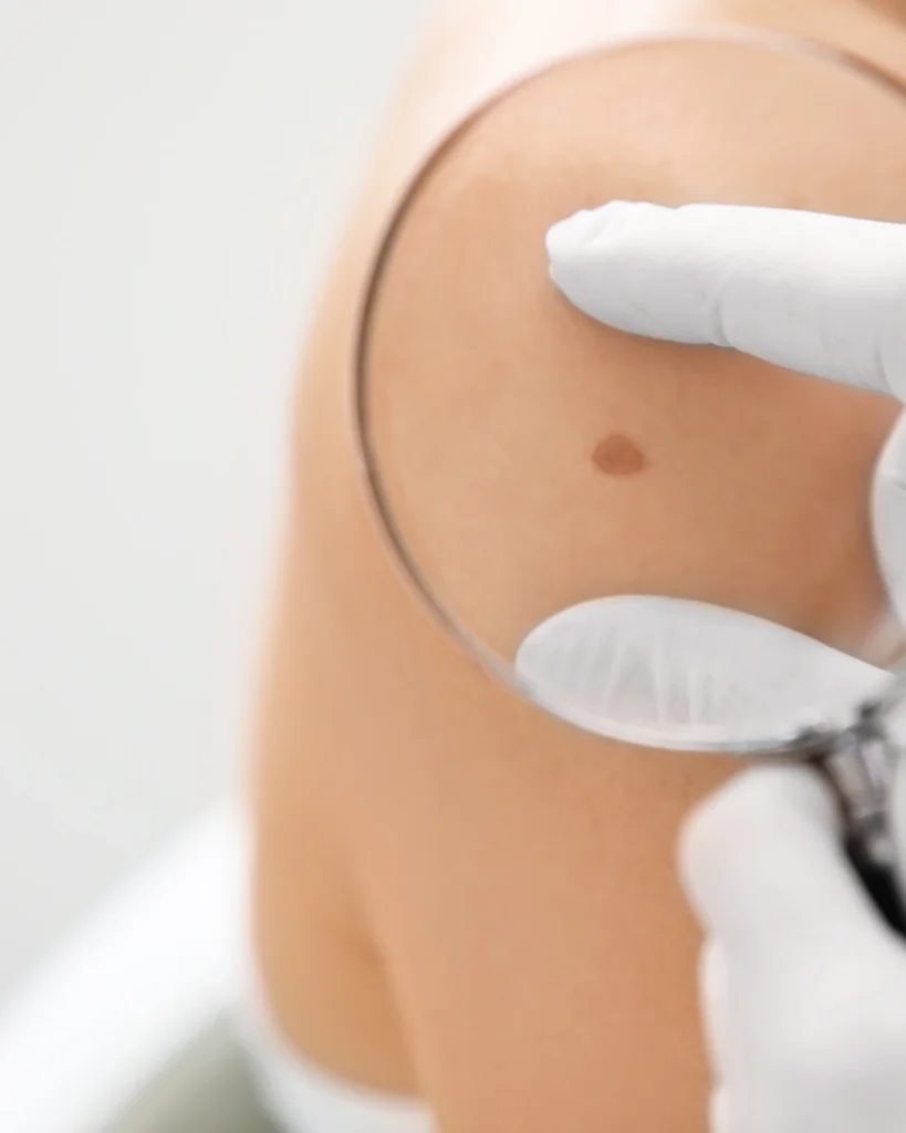birthmark removal (1)