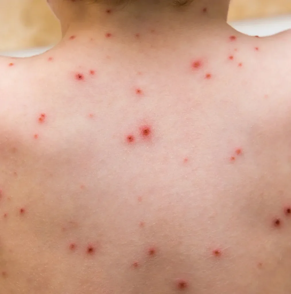 chicken-pox-scar-img