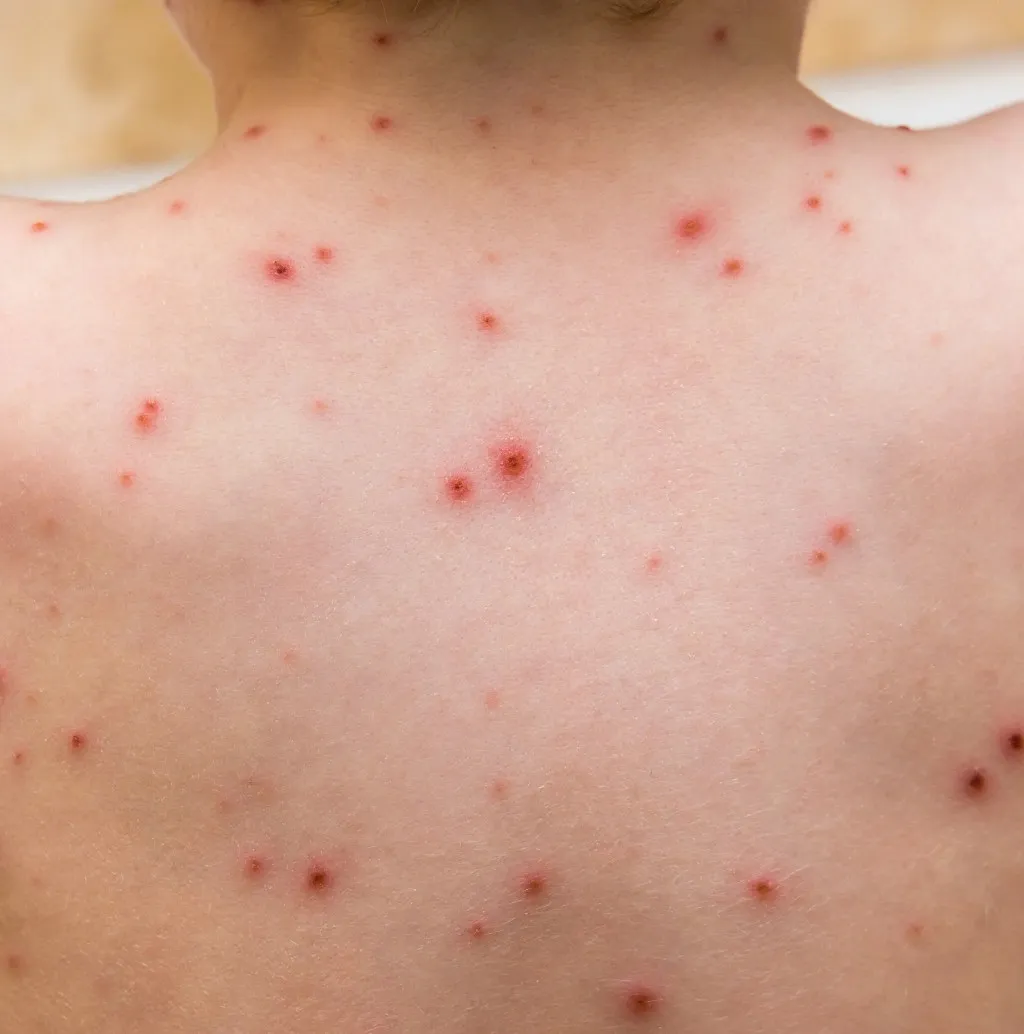 chicken-pox-scar-img
