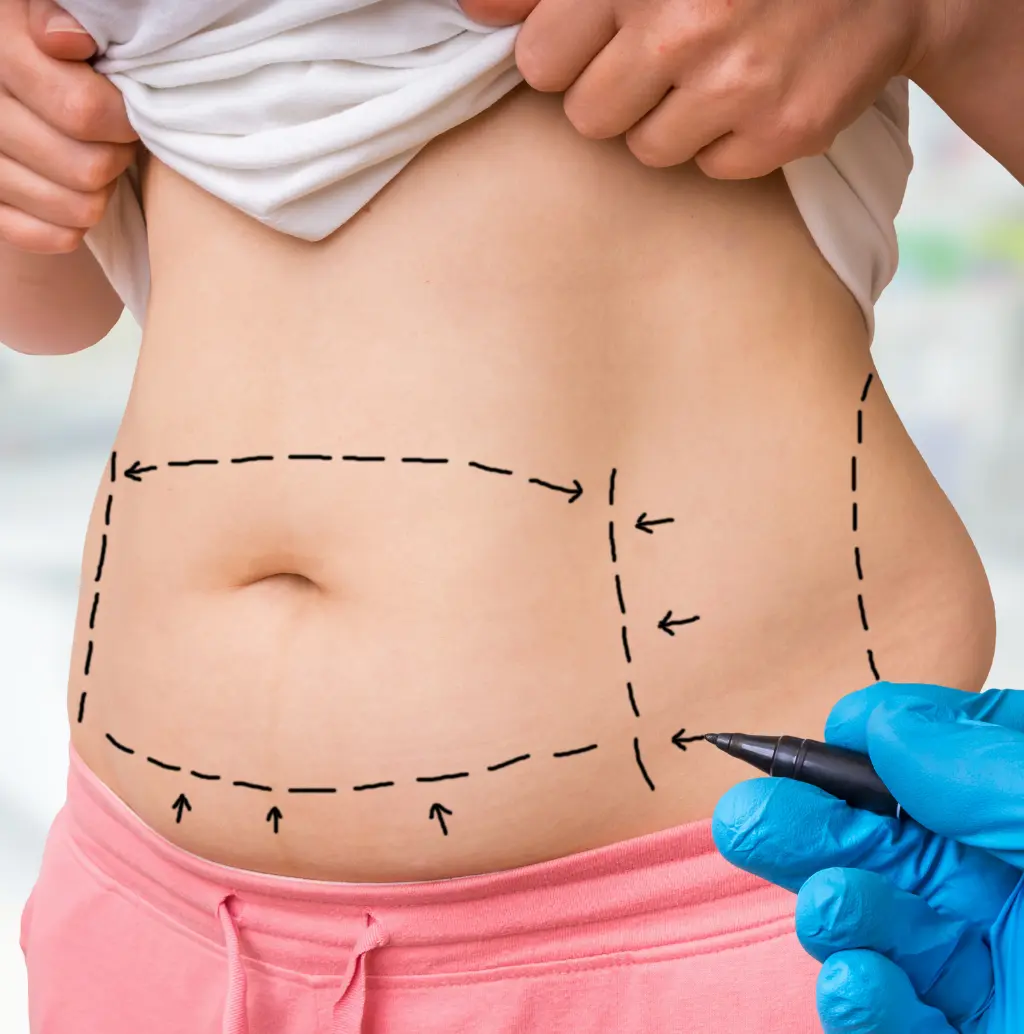 liposuction image
