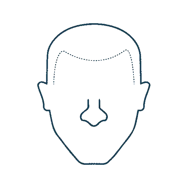 hairline-transplant