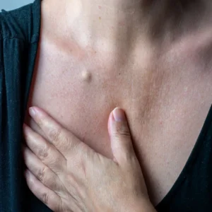 sebaceous-cyst
