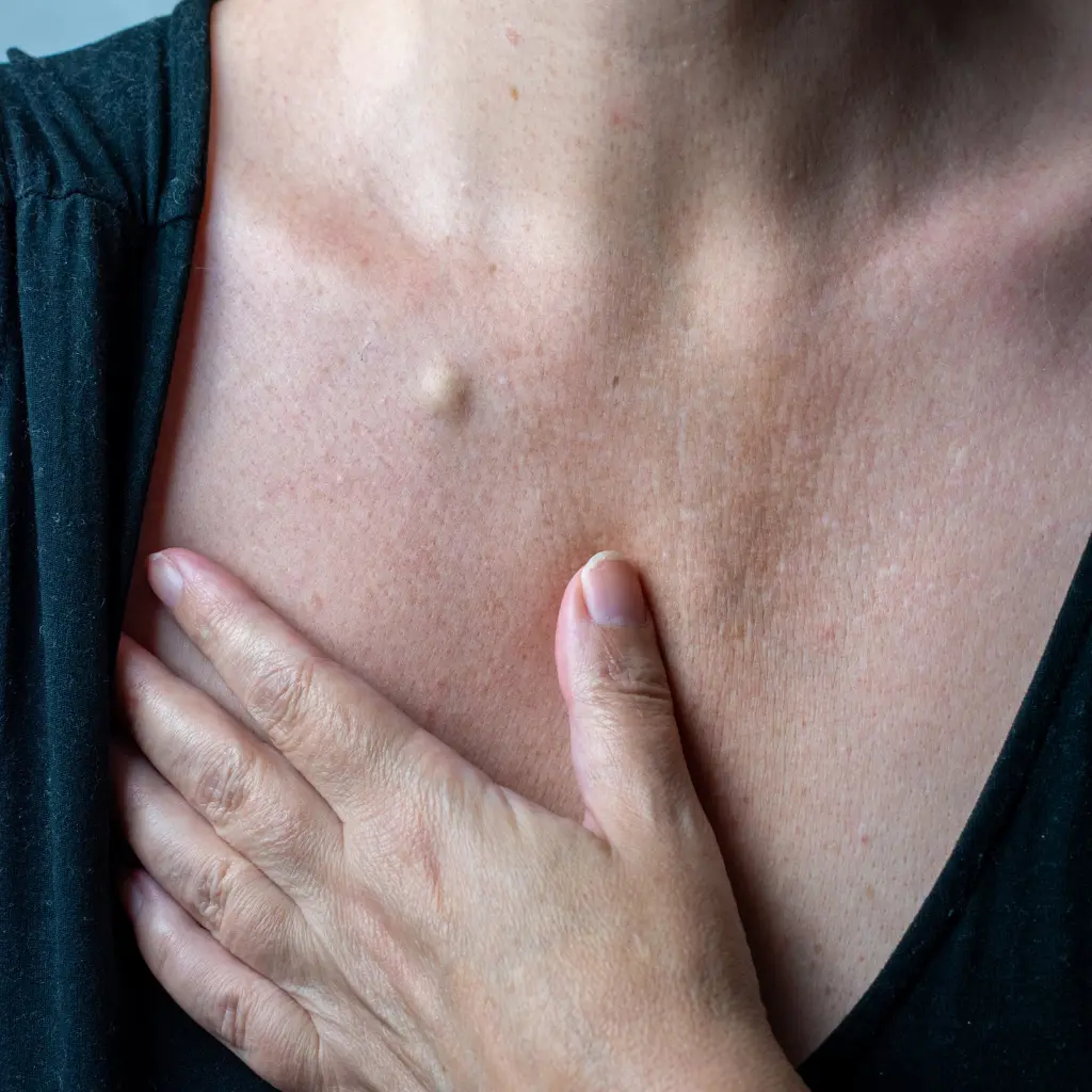 sebaceous-cyst