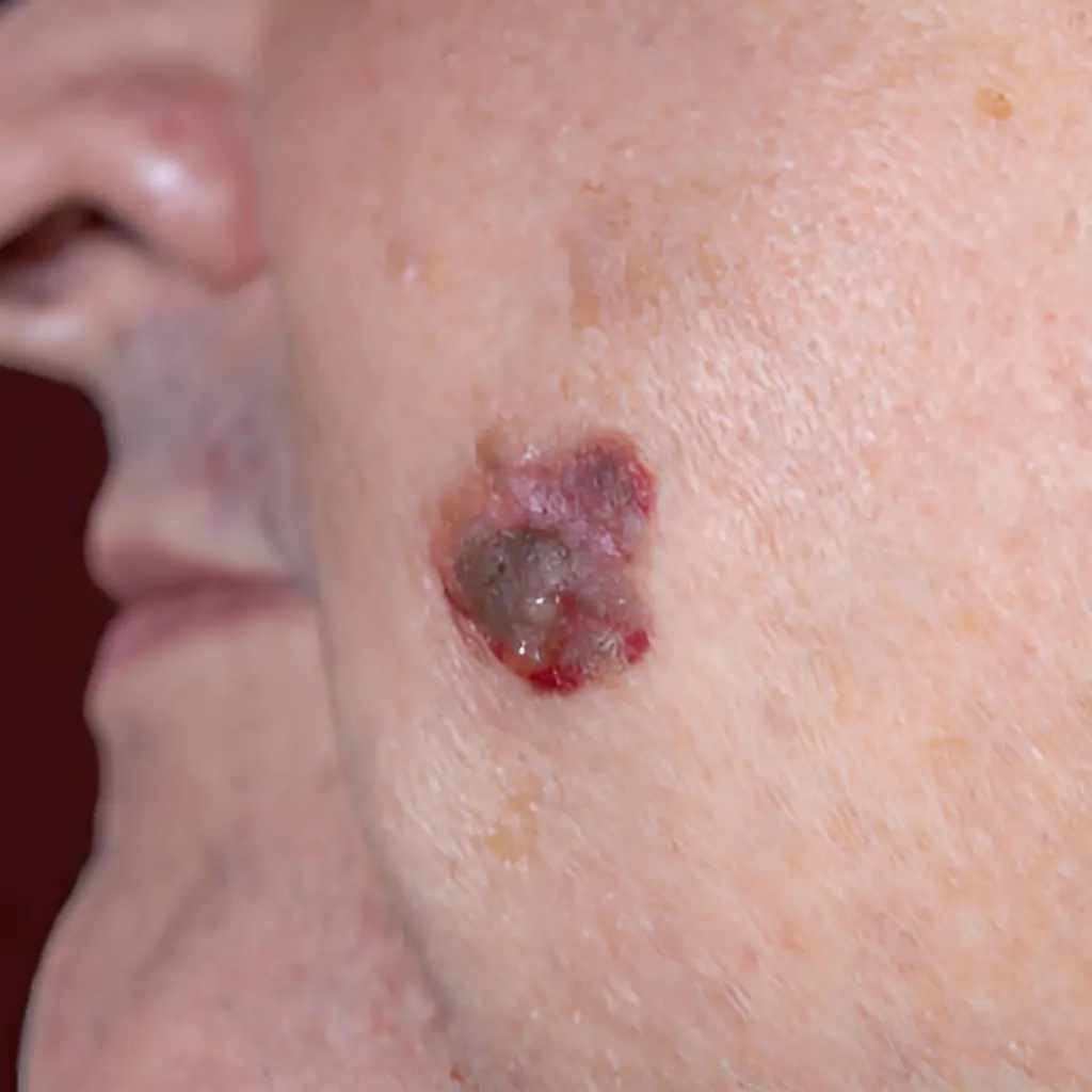 seborrheic keratosis image