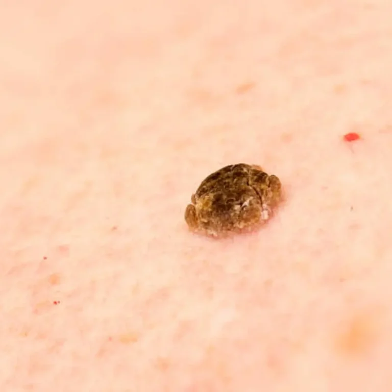 seborrheic keratosis10