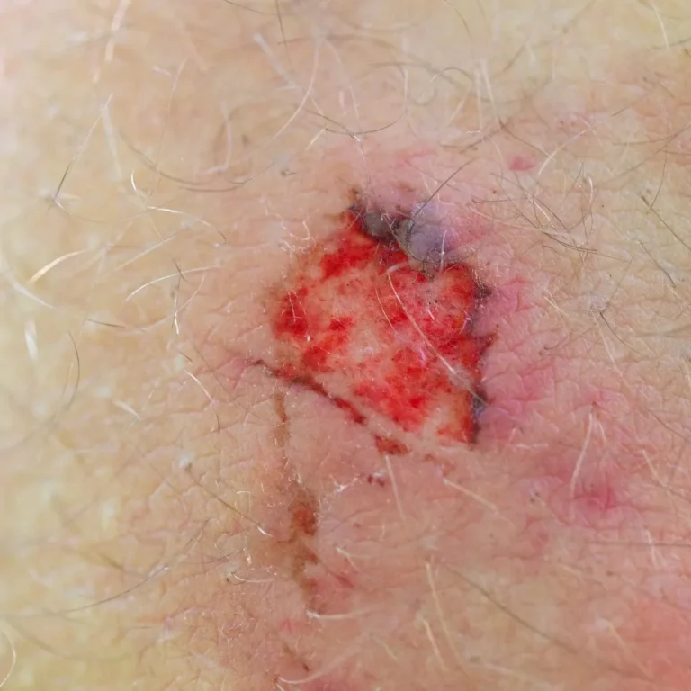 skin-lesion