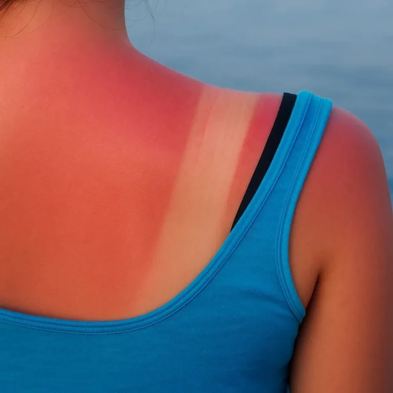 sunburn-removal-3