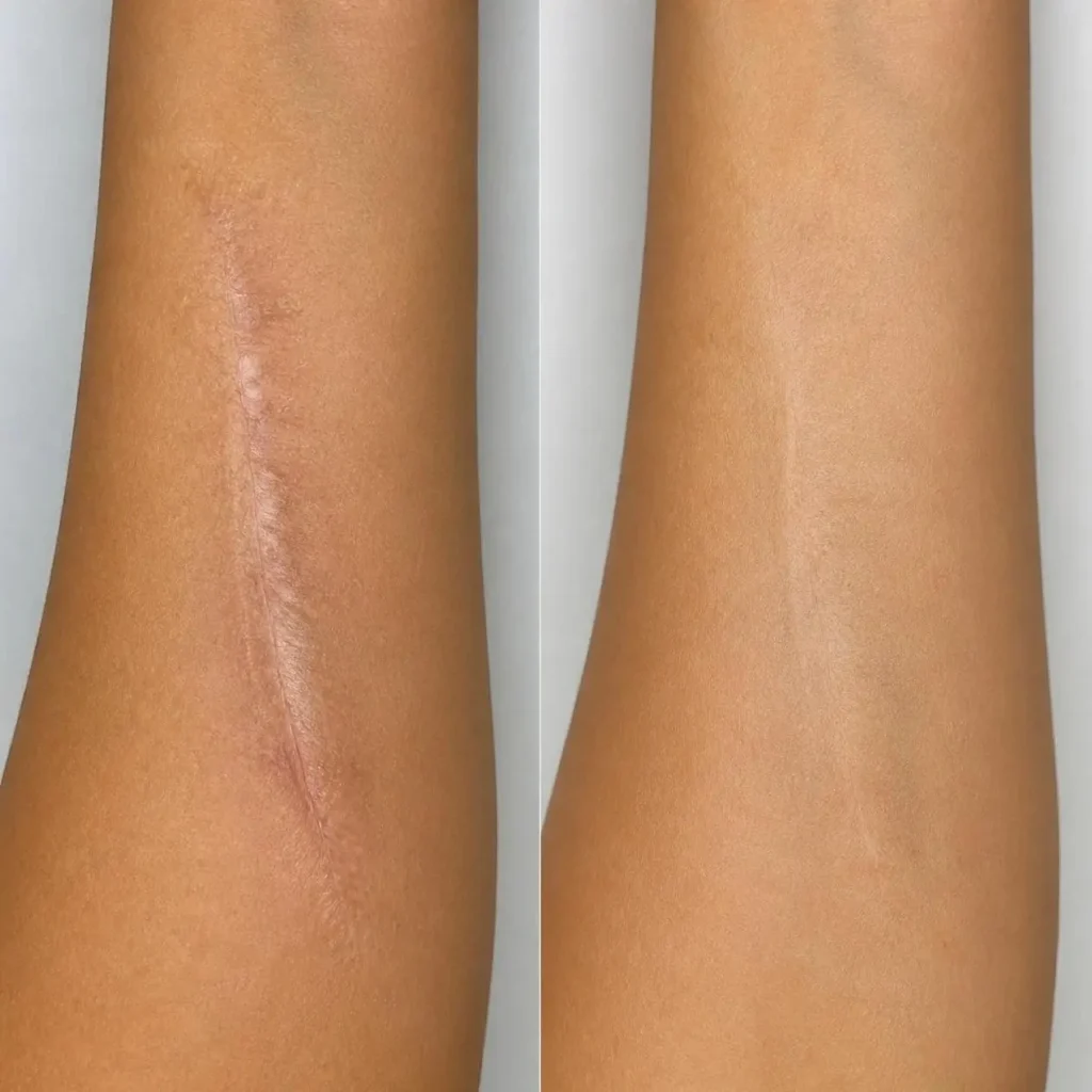 scar-revision-img