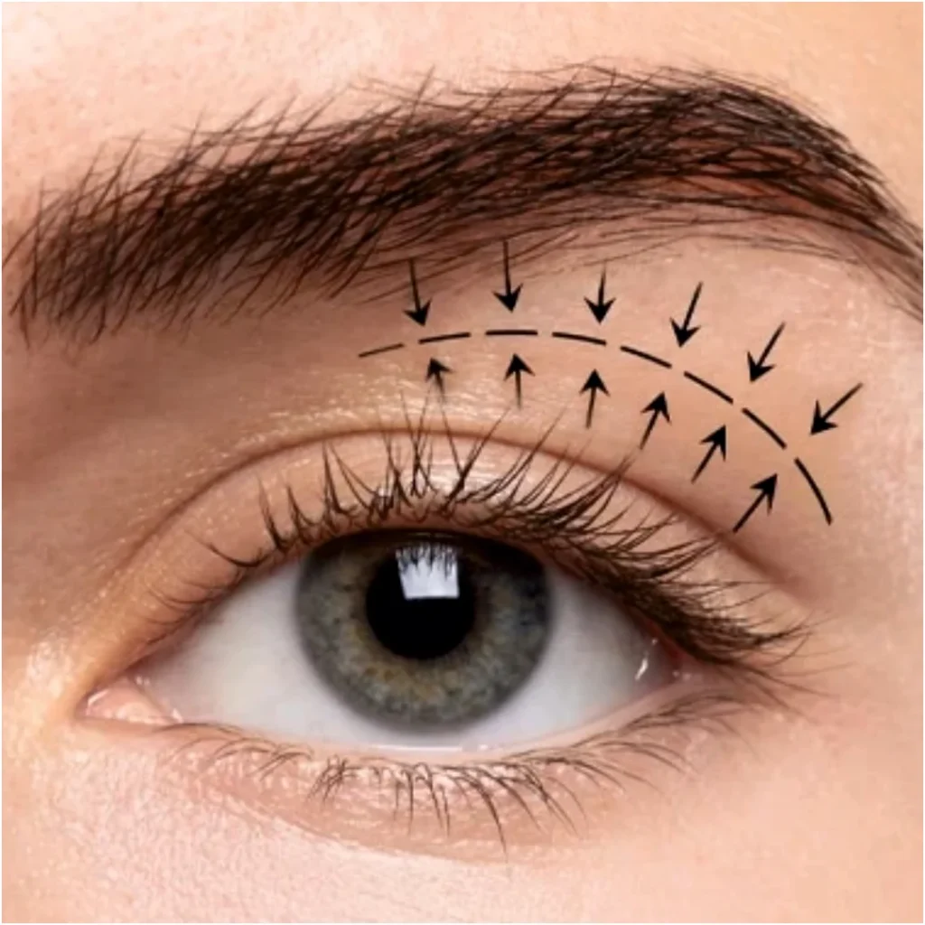 Blepharoplasty treatment 02