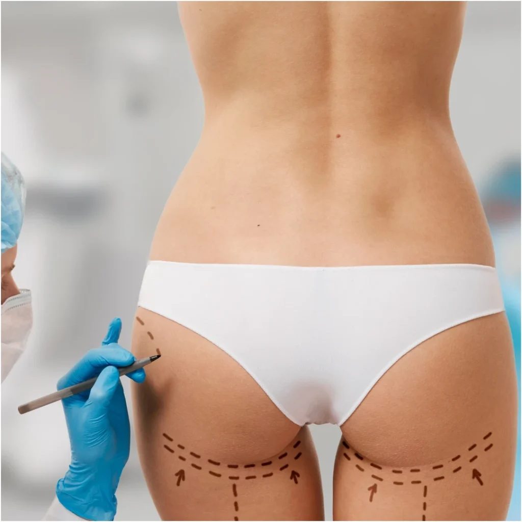 Brazilian buttock augmentation treatment 02