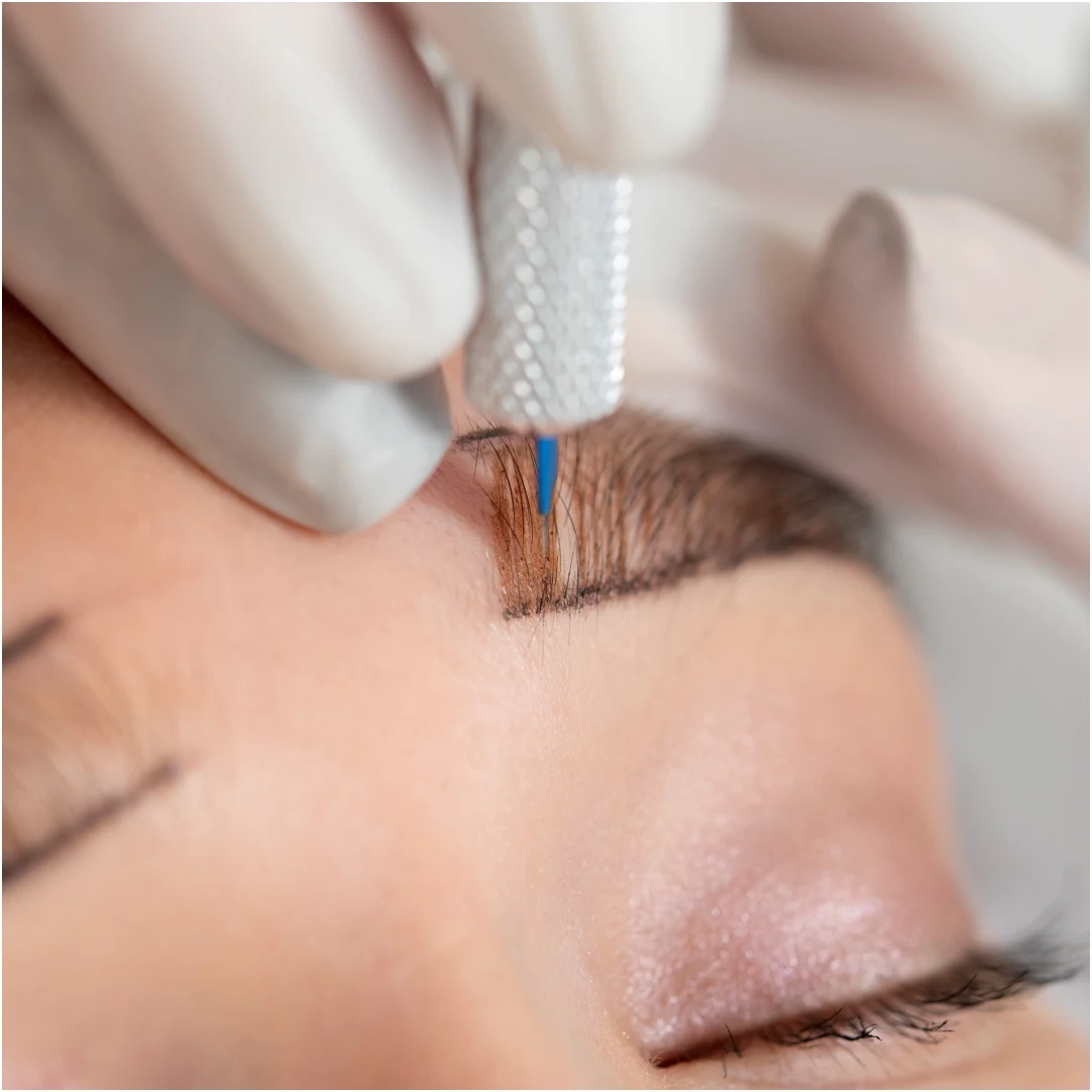 Brow lift treatment 04