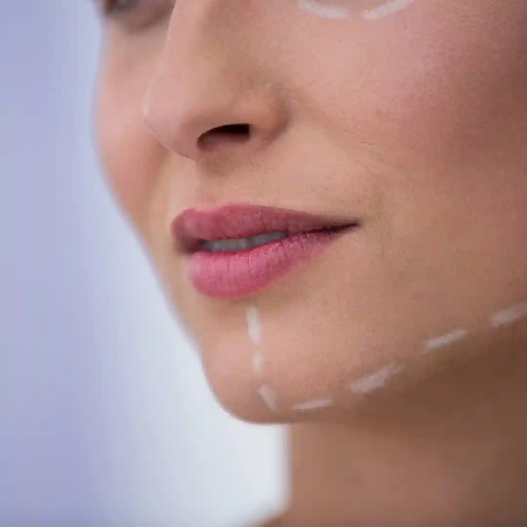 Chin Liposuction Treatment 01