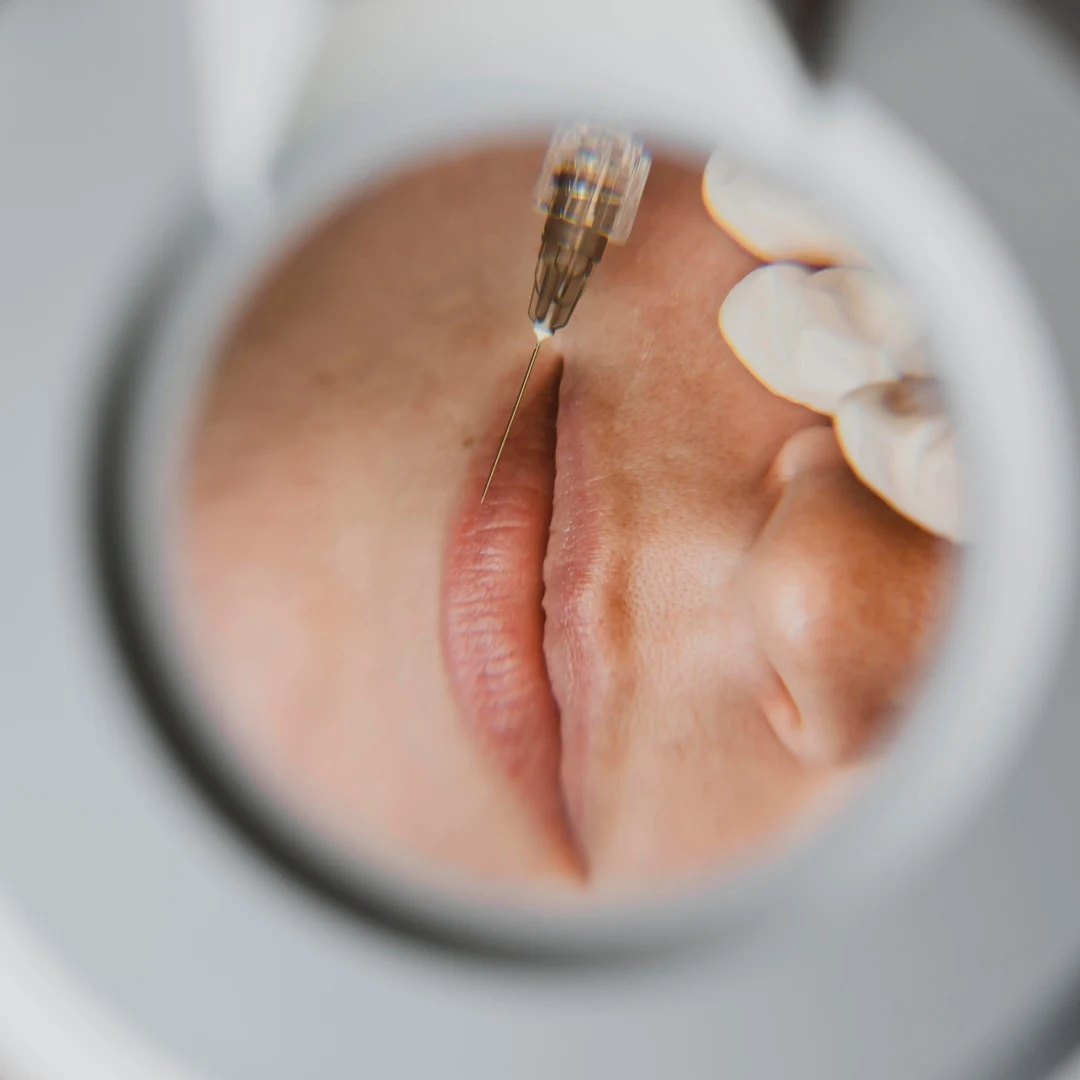 Dermal Fillers Treatment 01