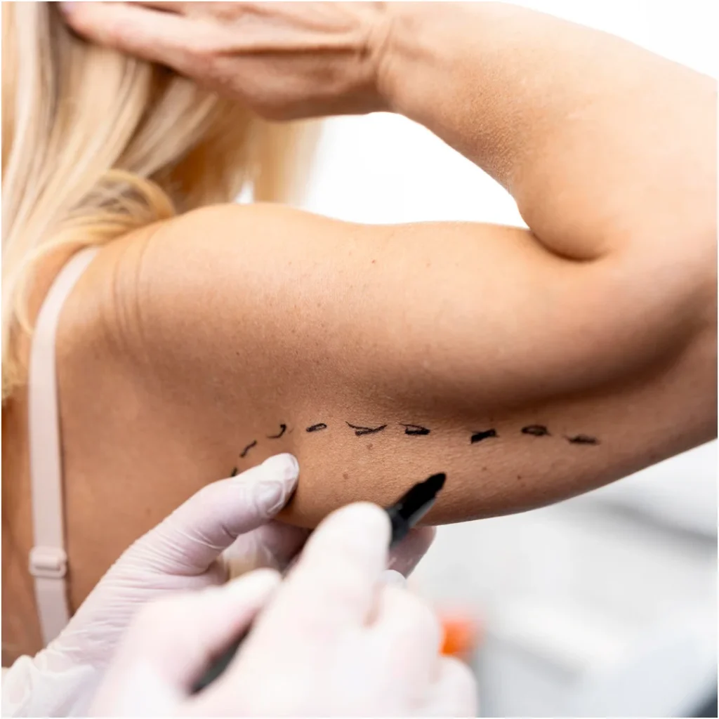 arm lift surgery 03