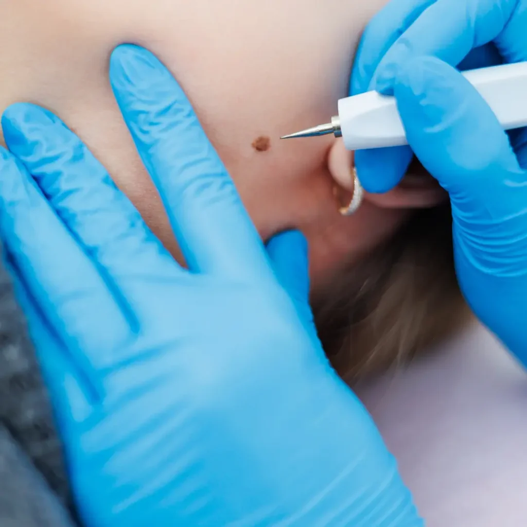 mole-removal