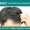 Mesotherapy_for_Effective_Hair_Restoration